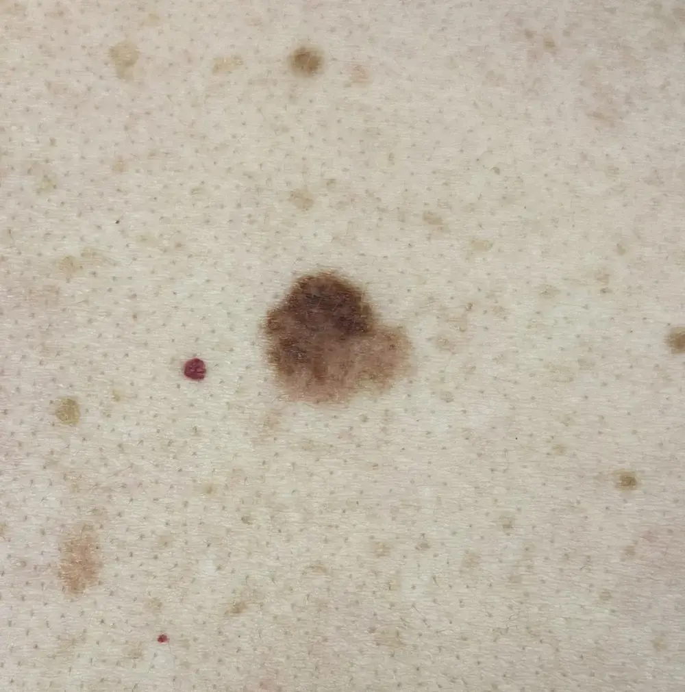 1. macroscopie van een atypische macula; ABCD niet pluis. Bron W. Engel kleiner