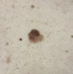 1. macroscopie van een atypische macula; ABCD niet pluis. Bron W. Engel kleiner