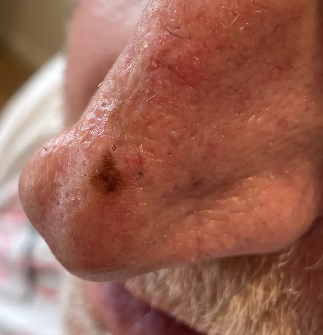 1. Macroscopie van een opvallende macula van de neus; ABCD niet pluis. Bron L. de Gier