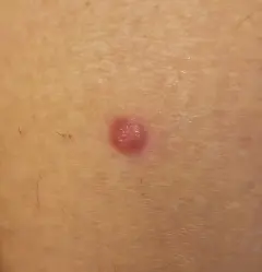 1. Macroscopie van een roze nodus. Bron R. van Doorn