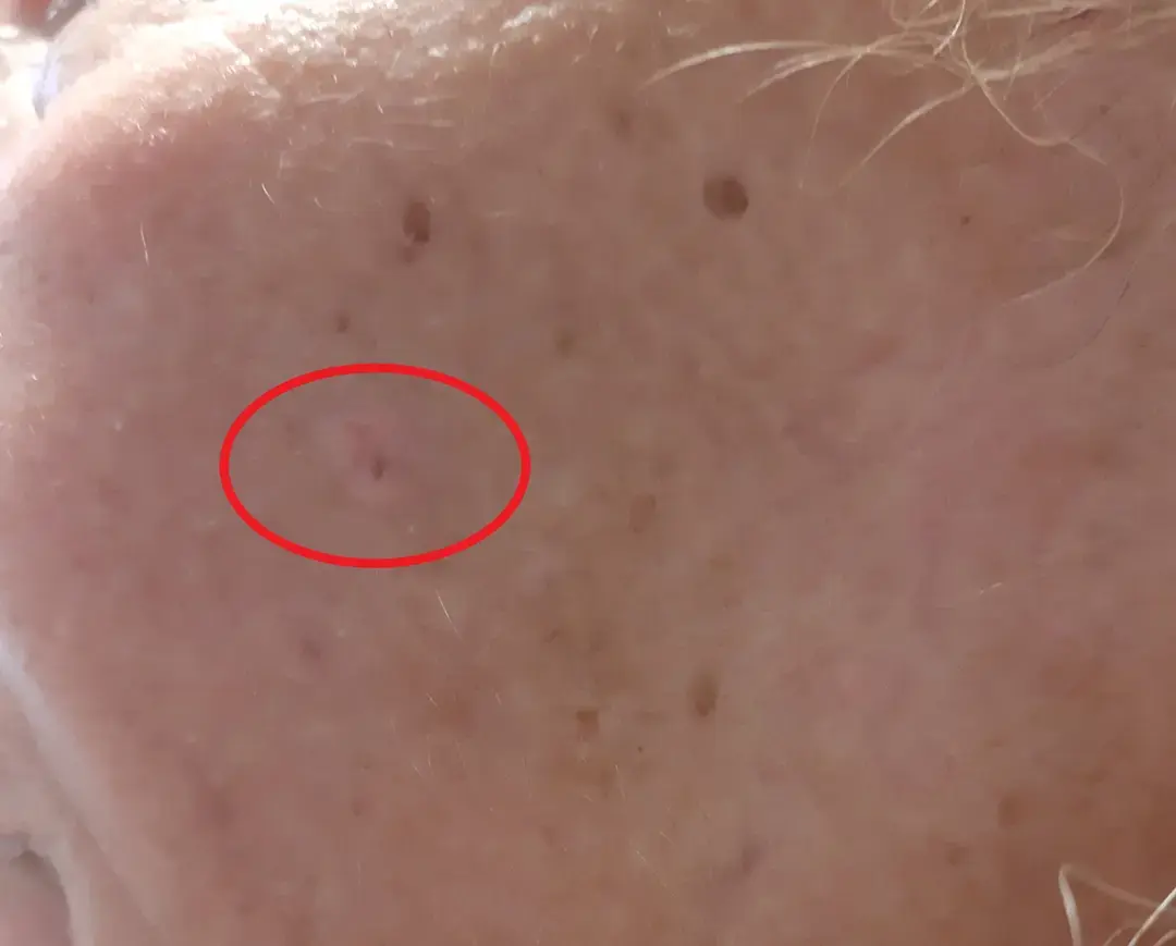 1. Macroscopie van een talgklierhyperplasie. Bron J. Moerman
