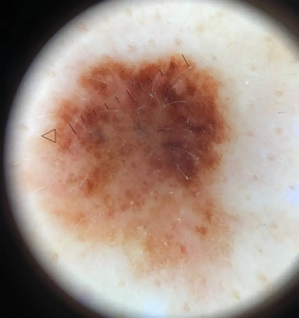 2. dermatoscopie laat asymmetrie van patronen en kleuren zien. Histopathologisch onderzoek toonde een dysplastische naevus. kleiner