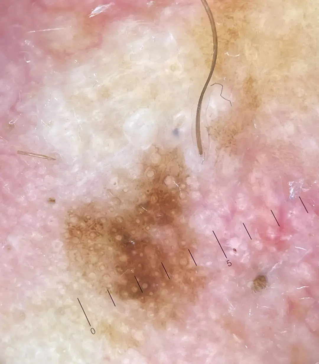 2. Dermatoscopie laat chaos van patronen en kleuren zien met een patroon van cirkels. Histoptahologisch onderzoek liet een lentigo maligna zien.