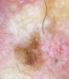 2. Dermatoscopie laat chaos van patronen en kleuren zien met een patroon van cirkels. Histoptahologisch onderzoek liet een lentigo maligna zien.