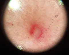 2. Dermatoscopie laat lineaire vaten in de periferie zien met centraal een huidkleurig roze patroon. Histopathologisch onderzoek liet een dermatofibroom zien.