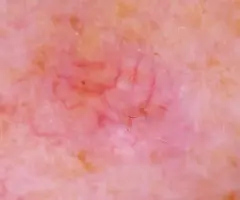 2. Dermatoscopie van een histopathologisch bevestigde talgklierhyperplasie