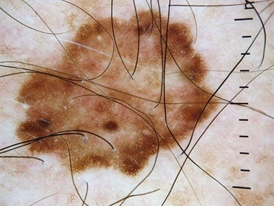 6.5 grenzen dermatoscopie casus schouder (1)