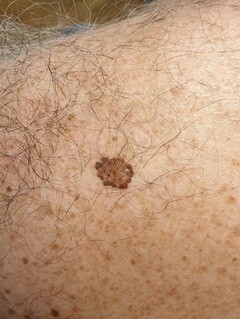6.5 grenzen dermatoscopie casus schouder (2)