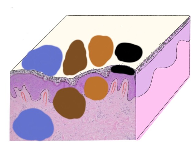 De betekenis van kleuren bij dermatoscopie