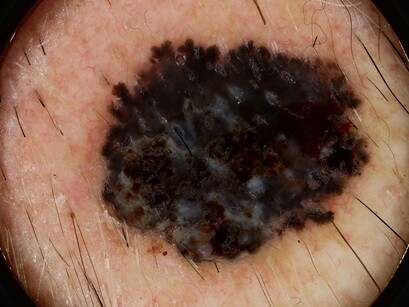Dermatoscopie huid van kleur bcc