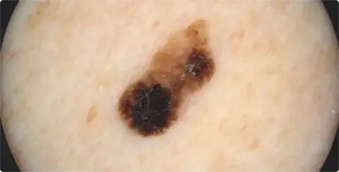 Dermatoscopie mét polraisatie van een verruca seborrhoica