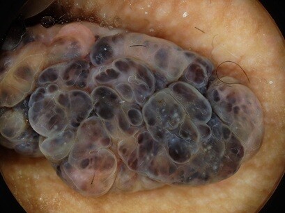 Dermatoscopie unna nevus 2
