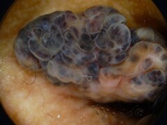 Dermatoscopie unna nevus