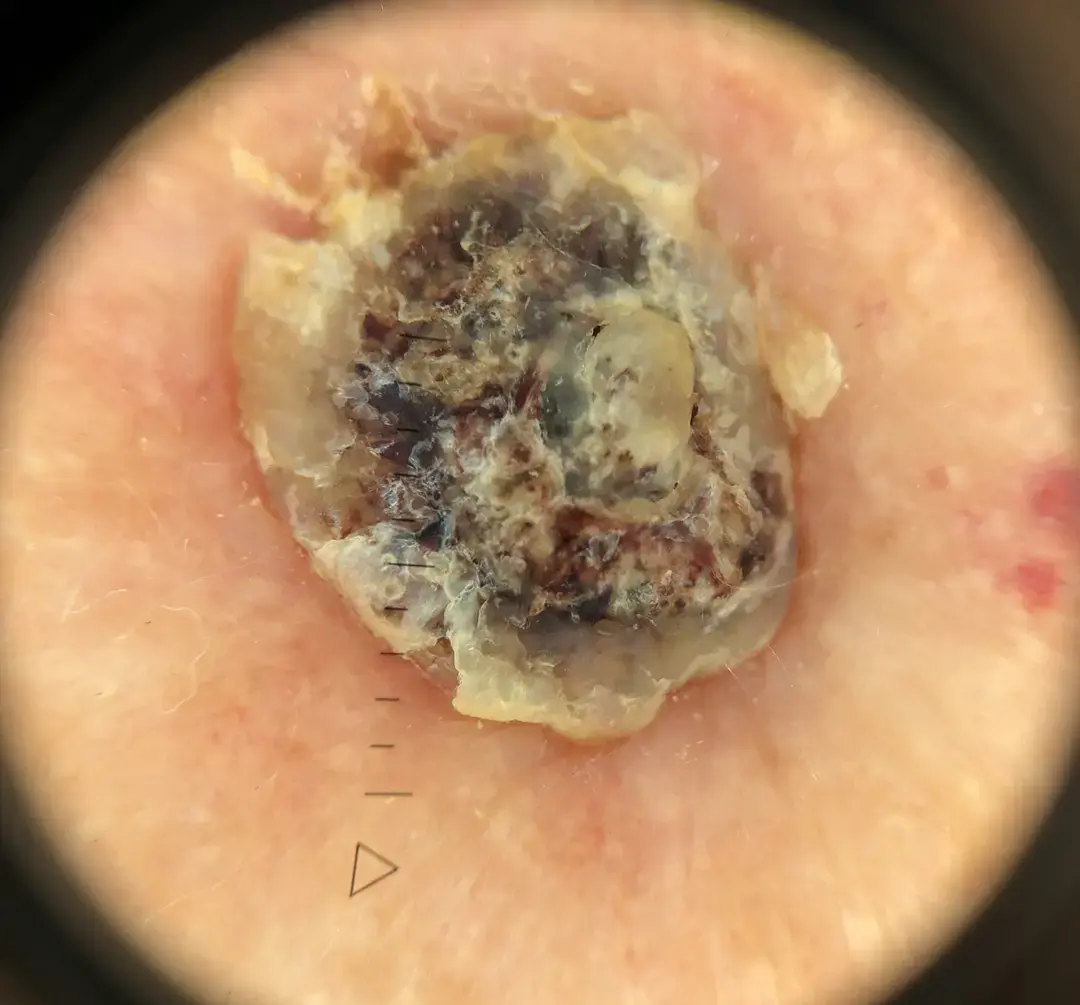 Dermatoscopie van een verruca seborrhoic met een meerkleurig patroon van klodders. De laesie bleek na enkele weken spontaan van de huid gevallen.