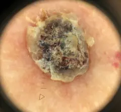 Dermatoscopie van een verruca seborrhoic met een meerkleurig patroon van klodders. De laesie bleek na enkele weken spontaan van de huid gevallen.