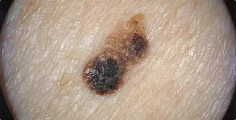 Dermatoscopie zonder poarisatie van een verruca seborrhoica