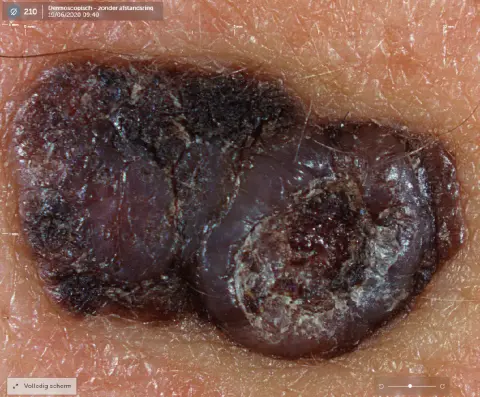 Dermatoscopie zonder polarisatie van een nodulair melanoom
