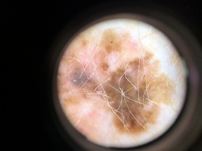 Follow up na 2 jaar
