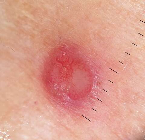 H2 overzicht Dermatofibroom resize