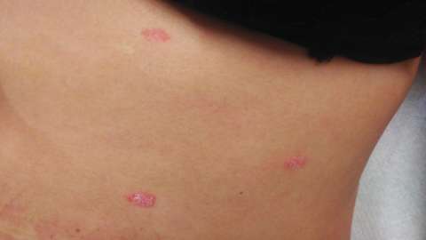 macroscopie psoriasis guttata