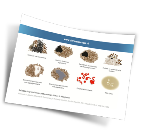 Melanoom patronen  pathologische variant