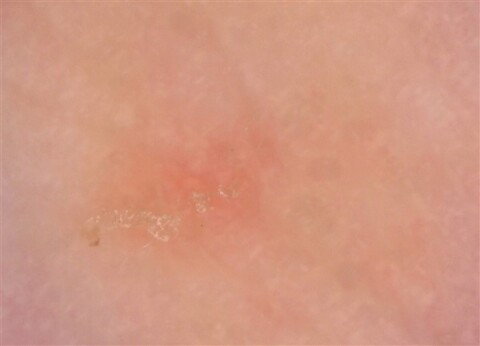 Scabies (600 x 433)