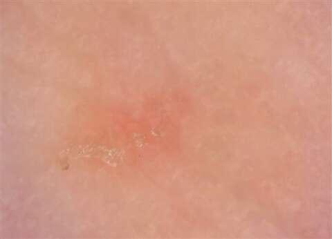 Scabies (600 x 433)