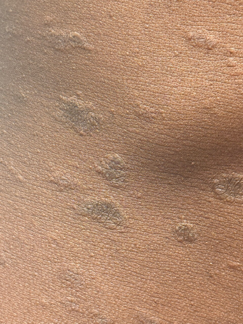 Tinea corprois huid van kleur  (1)