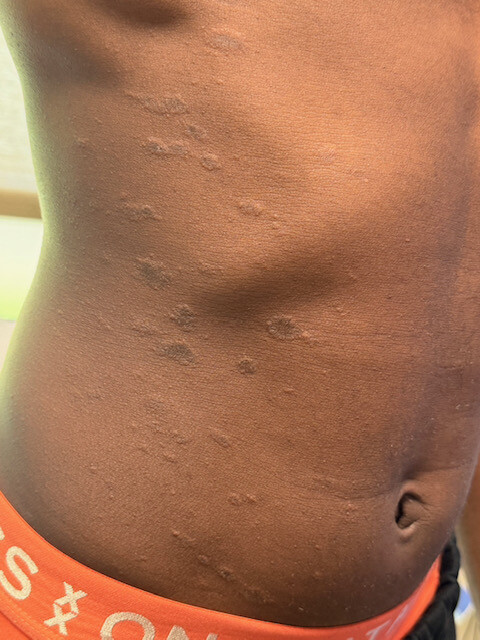 Tinea corprois huid van kleur  (2)