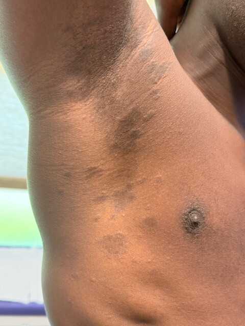 Tinea corprois huid van kleur  (3)